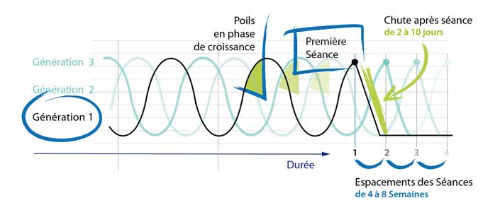 Principe et Le résultats du laser pour votre épilation 